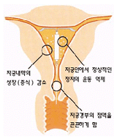 자궁내 장치